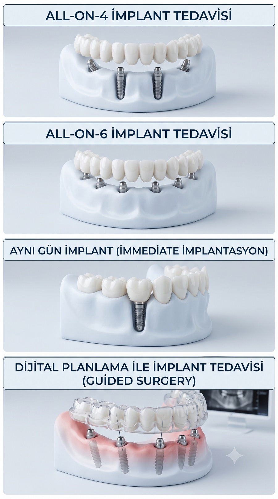 All-on-4 İmplant Tedavisi